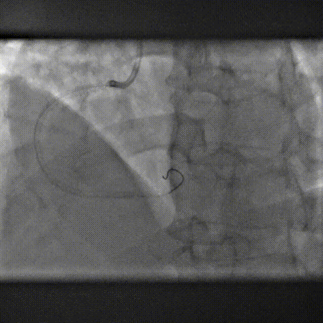 Launcher病例荟 | SAL导管在钙化病变中的应用