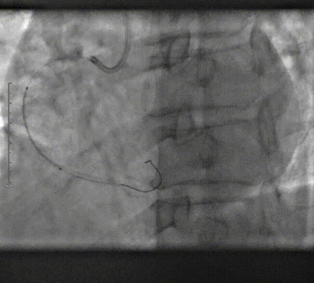 Launcher病例荟 | SAL导管在钙化病变中的应用