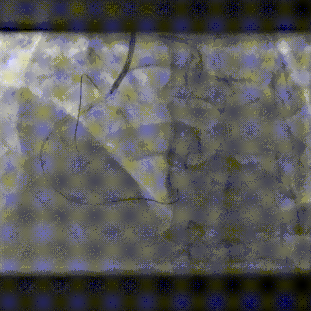 Launcher病例荟 | SAL导管在钙化病变中的应用