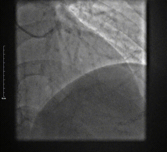 Launcher病例荟 | SAL导管在钙化病变中的应用