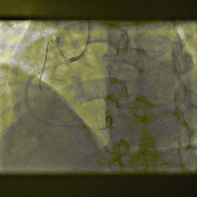 Launcher病例荟 | SAL导管在钙化病变中的应用