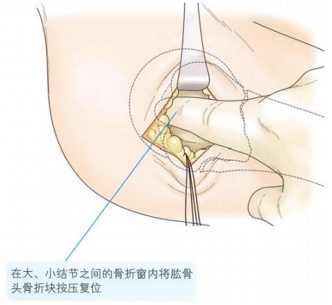 肱骨近端骨折切开复位内固定手术技术