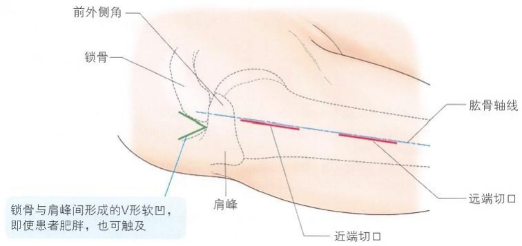 肱骨近端骨折切开复位内固定手术技术