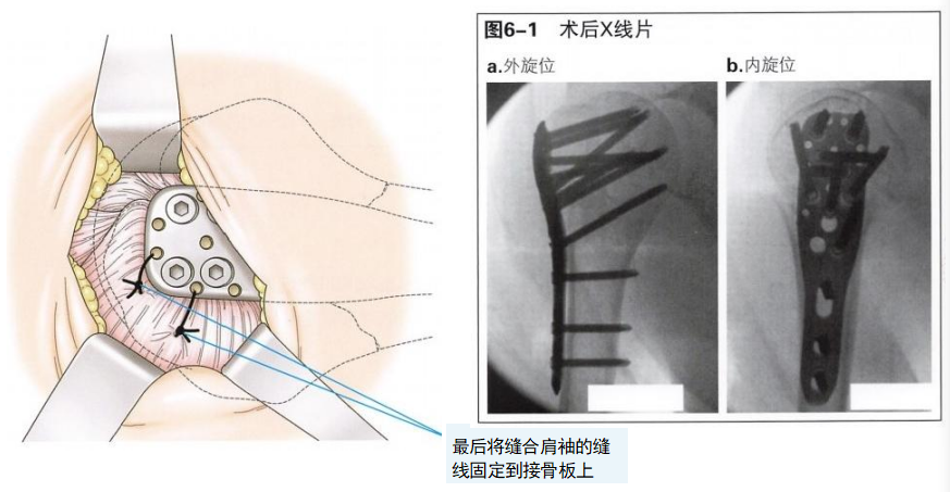 肱骨近端骨折切开复位内固定手术技术