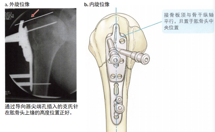 肱骨近端骨折切开复位内固定手术技术