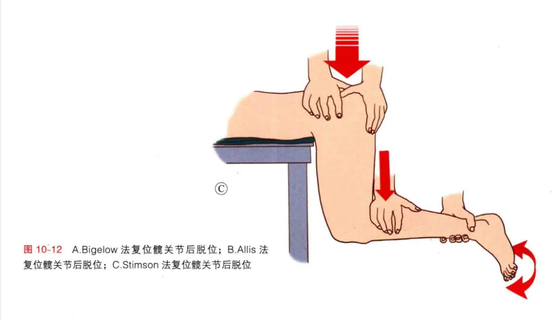 急诊来了髋关节脱位如何复位?骨科值班必备五种髋关节脱位闭合复位法!