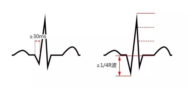 急性心梗心电图,各阶段特点及异常Q波的诊断与鉴别诊断
