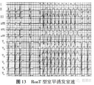 常见心律失常的急诊处理(心血管医生值班必备)