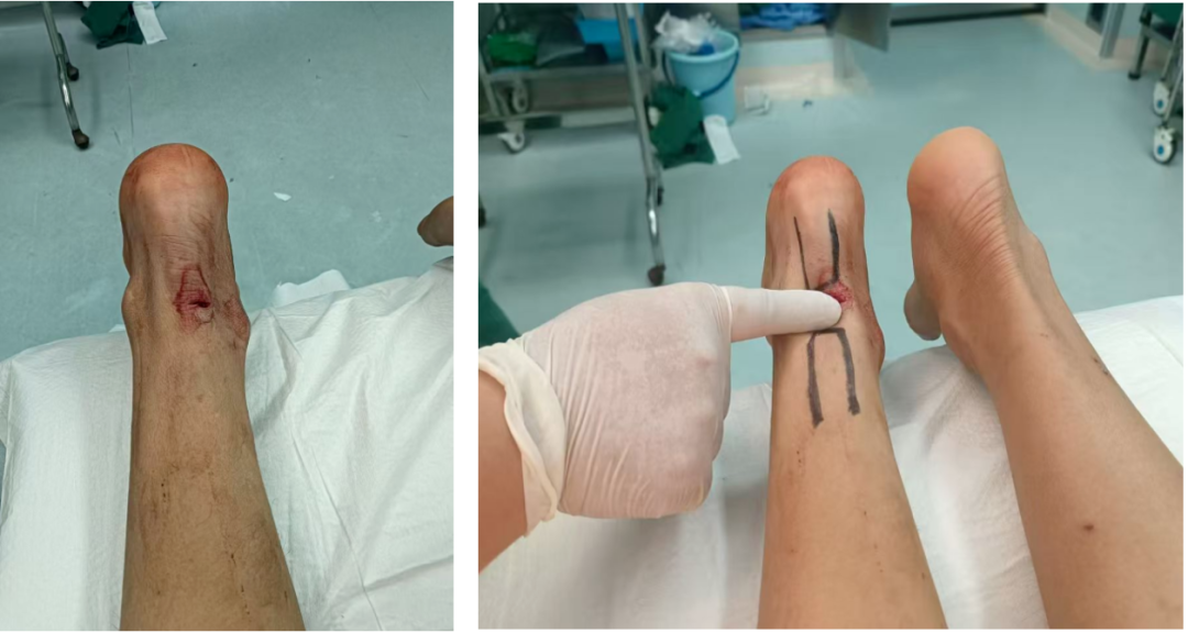 跟腱断裂的微创治疗,你都掌握了吗?