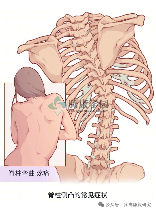 脊柱侧弯的危害、评估及