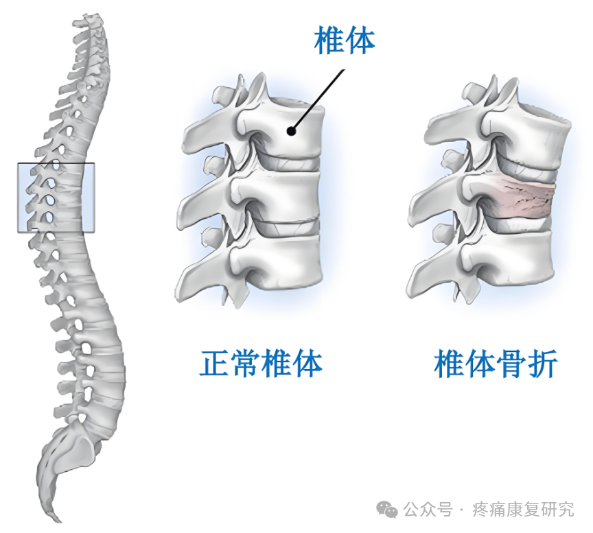 脊柱侧弯的危害、评估及
