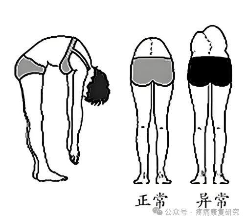 脊柱侧弯的危害、评估及