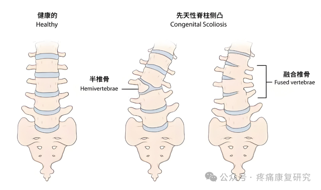 脊柱侧弯的危害、评估及