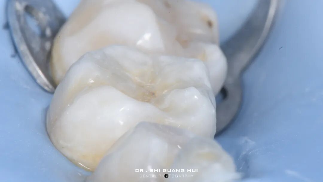 深边缘提升的再思考(龈壁提升的操作细节)