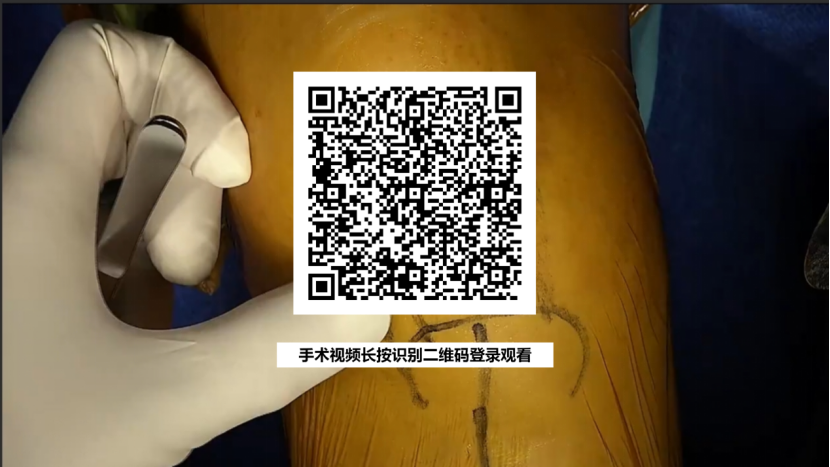 【手术视频】双侧固定平台单髁置换术