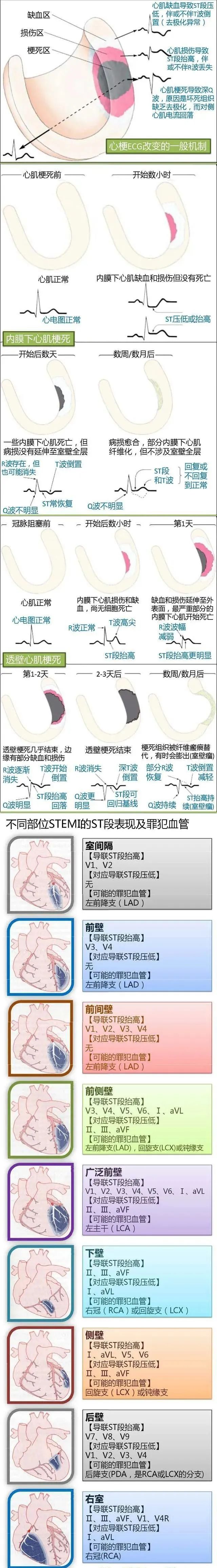 急性心肌梗死进行PCI的时间窗