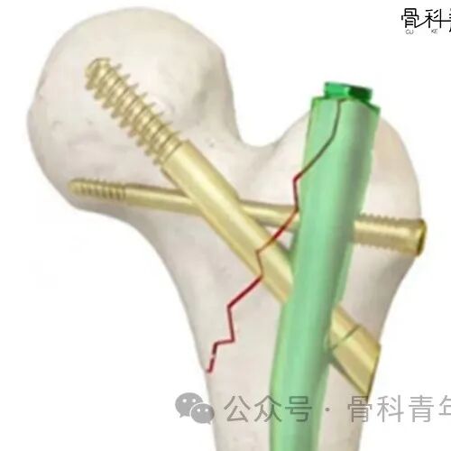 新型PFUN,会是粗隆间骨折内固定的更优解吗?