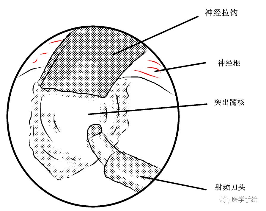 图文结合:单侧双通道内镜技术(UBE)原来没这么难!