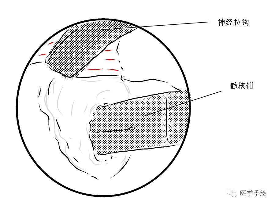 图文结合:单侧双通道内镜技术(UBE)原来没这么难!