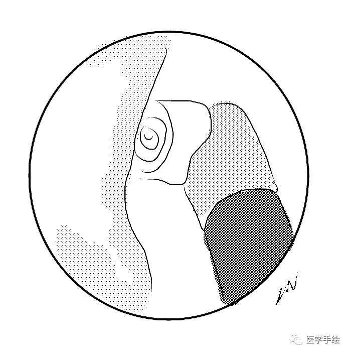 图文结合:单侧双通道内镜技术(UBE)原来没这么难!