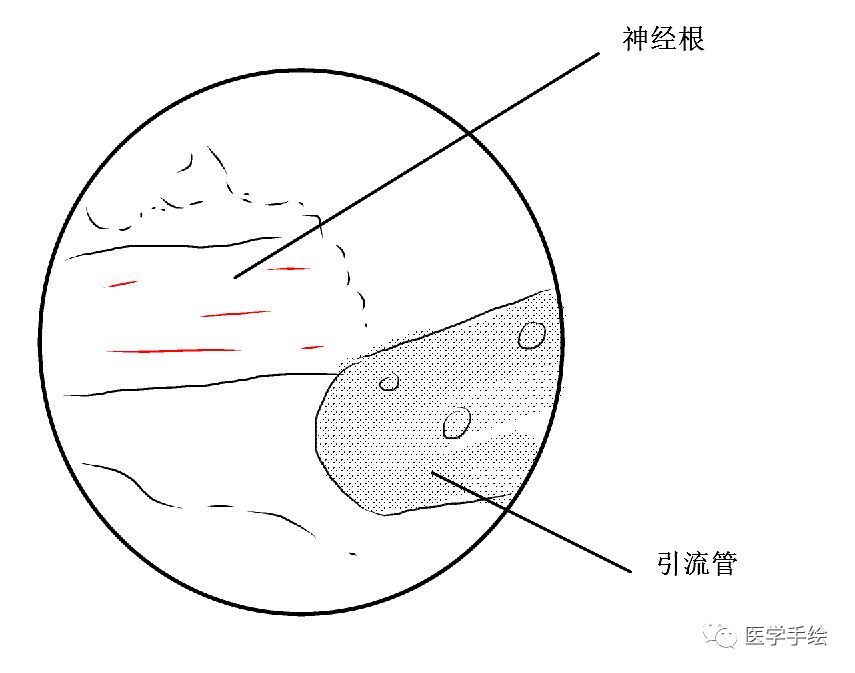 图文结合:单侧双通道内镜技术(UBE)原来没这么难!