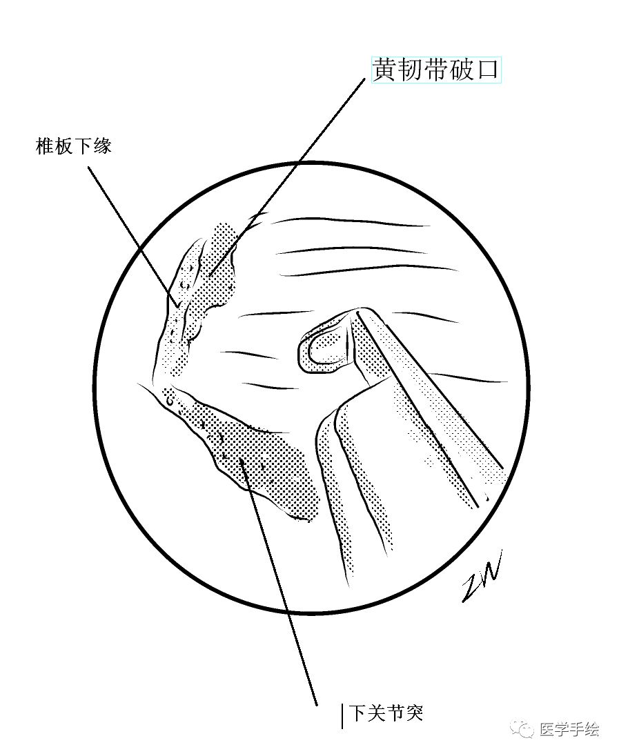 图文结合:单侧双通道内镜技术(UBE)原来没这么难!