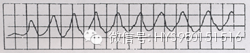 值班碰到严重心律失常如何处理?