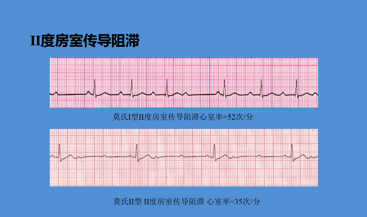 恶性心律失常的急诊识别与处理(含ppt详解)
