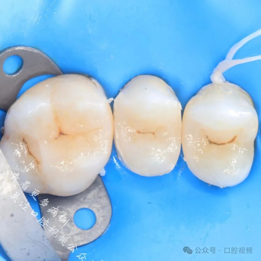 患者主诉食物嵌塞,我这样修复接触点... - 好医术文章 - 好医术-赋能医生守护生命