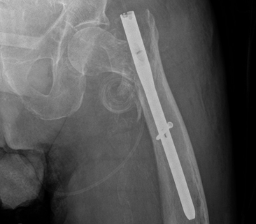 “任性的螺钉”:头髓拉力螺钉盆腔内移位的罕见病例报道