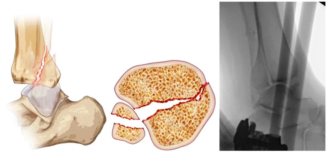 JBJS:后踝骨折、后Pilon骨折及后Pilon变异型骨折的定义与治疗