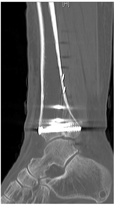 JBJS:后踝骨折、后Pilon骨折及后Pilon变异型骨折的定义与治疗