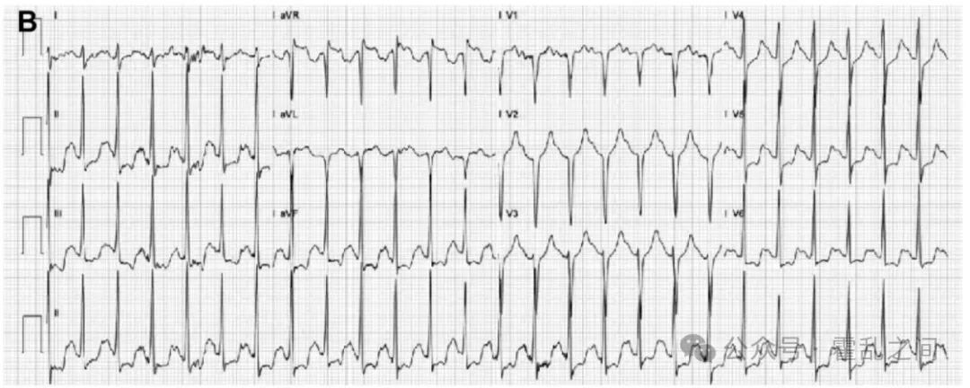 前降支心肌桥的“葛氏三联征”,过度焦虑也需被关注