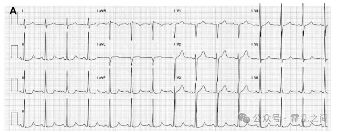 前降支心肌桥的“葛氏三联征”,过度焦虑也需被关注