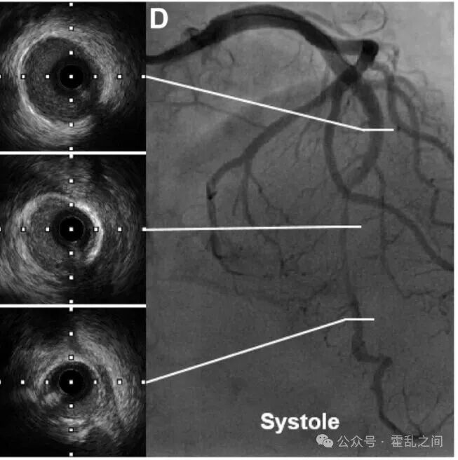 前降支心肌桥的“葛氏三联征”,过度焦虑也需被关注