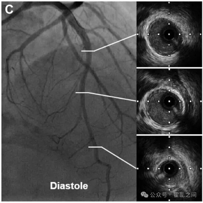 前降支心肌桥的“葛氏三联征”,过度焦虑也需被关注