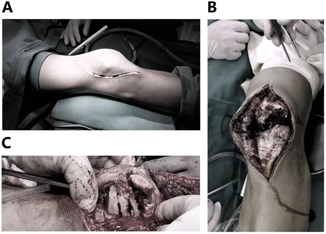 髌旁外侧入路联合“刺猬”技术治疗复杂粉碎性髌骨骨折