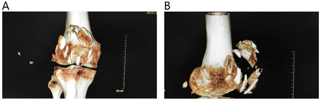 髌旁外侧入路联合“刺猬”技术治疗复杂粉碎性髌骨骨折