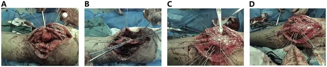 髌旁外侧入路联合“刺猬”技术治疗复杂粉碎性髌骨骨折