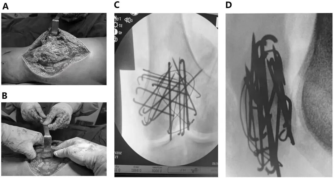 髌旁外侧入路联合“刺猬”技术治疗复杂粉碎性髌骨骨折