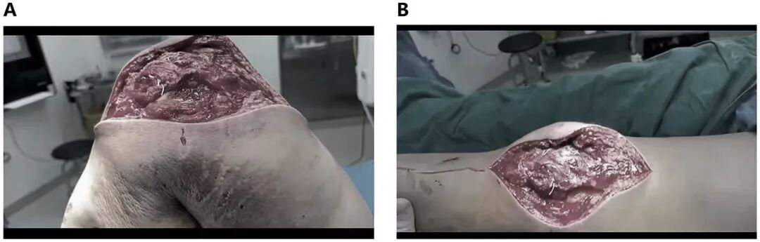 髌旁外侧入路联合“刺猬”技术治疗复杂粉碎性髌骨骨折