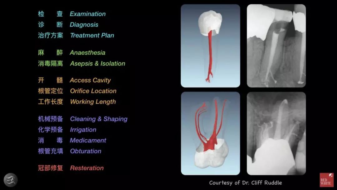 三种根充材料临床使用效果对比,你常用的是哪种?