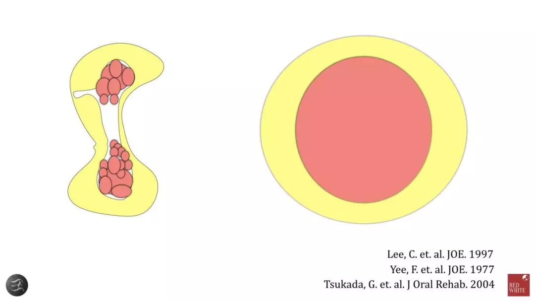 三种根充材料临床使用效果对比,你常用的是哪种?