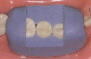 三根车针,六步完成——快速磨牙全冠预备