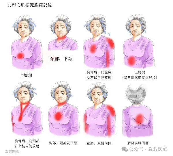 急性心肌梗死,2025最新诊疗指南总结