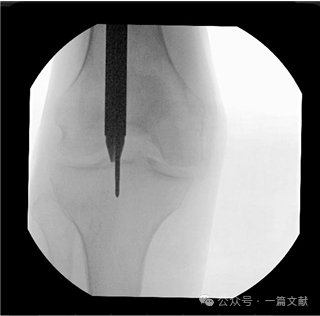 图解胫骨髓内钉技术（2025）