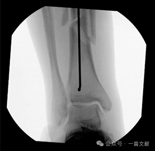 图解胫骨髓内钉技术（2025）