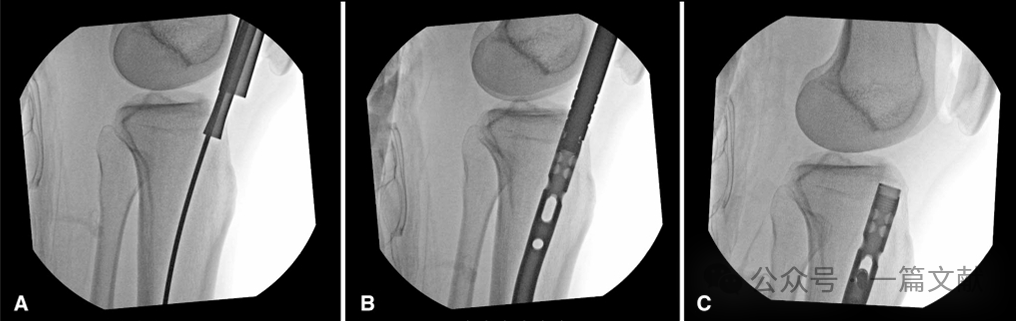 图解胫骨髓内钉技术（2025）