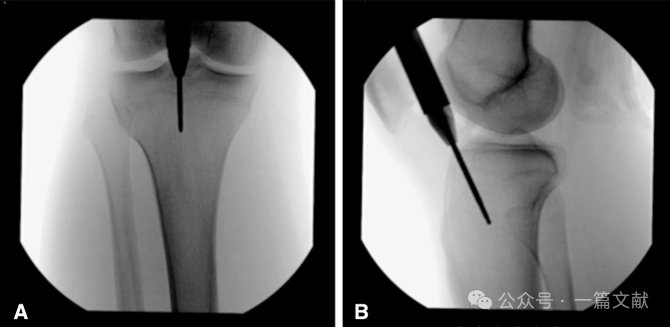 图解胫骨髓内钉技术（2025）