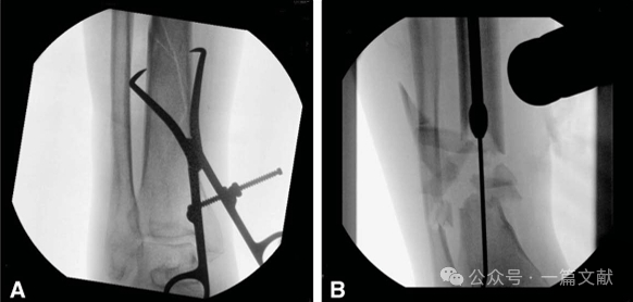 图解胫骨髓内钉技术（2025）